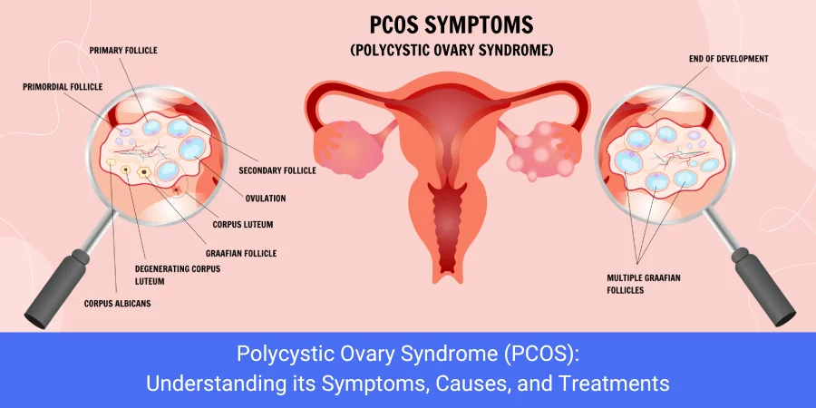PCOS Symptoms and Treatment by Dr. Nidhi Nagar – PCOS Treatment in Bhopal