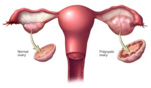 Comparison of normal ovary and polycystic ovary showing multiple cysts in PCOS