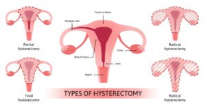 Types of hysterectomy surgery including total, partial and radical hysterectomy explained for Hysterectomy Surgery in Bhopal