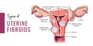 Types of uterine fibroids diagram showing intramural, submucosal, subserosal, and pedunculated fibroids in the uterus