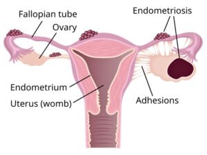 Advanced laparoscopic endometriosis surgery in Bhopal by experienced gynecologist Bhopal